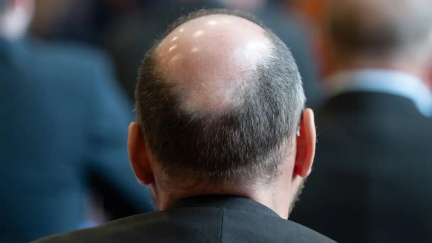 sugar gel cure baldness