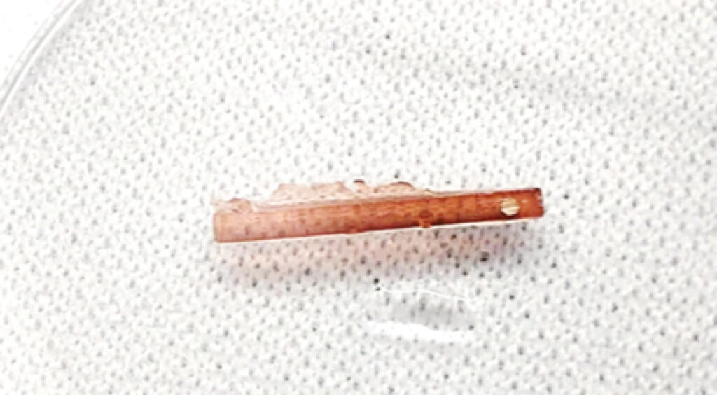 tiny magnetic robot dissolve kidney stones