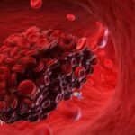intermittent fasting heart blood clots