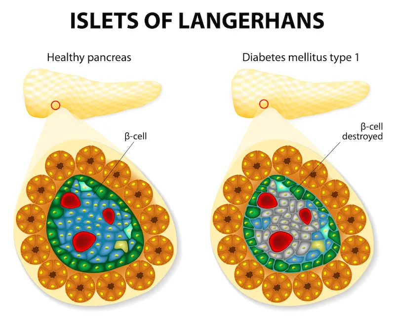 CRISPR Pancreatic Transplant Helps Diabetes Patient