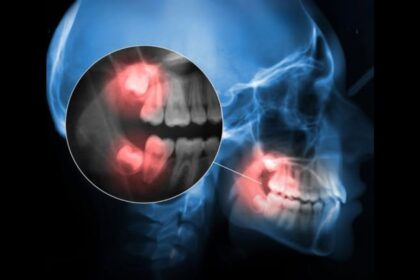 Stem Cells Found In Wisdom Teeth