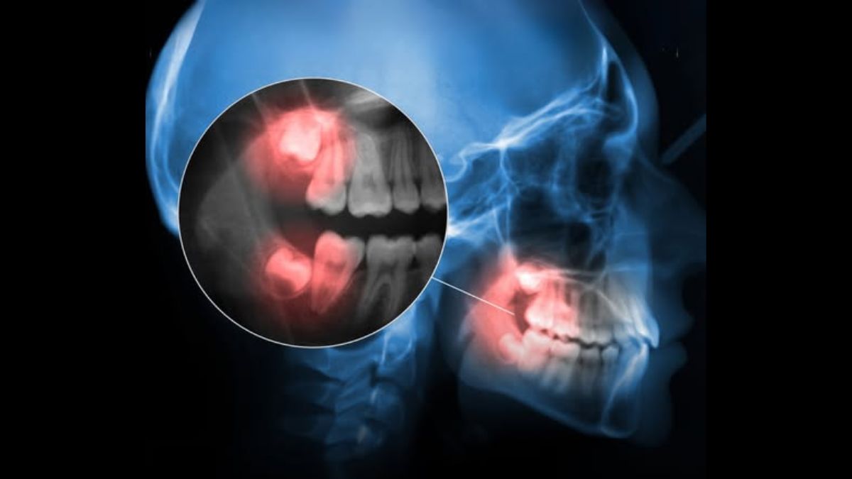 Stem Cells Found In Wisdom Teeth