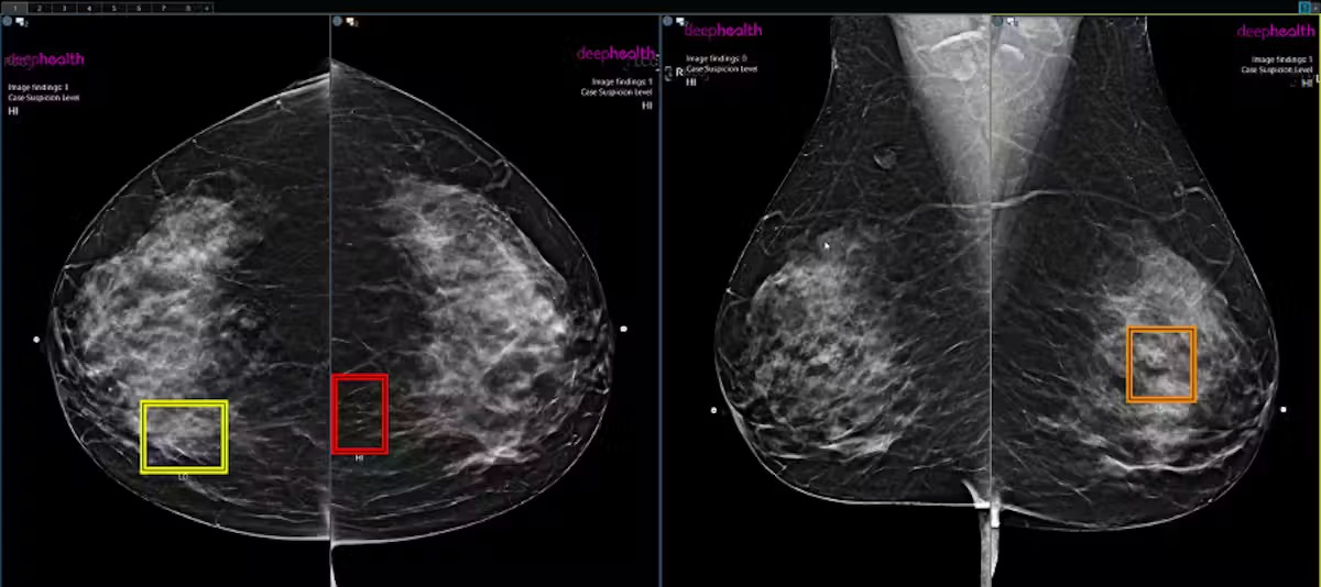 AI Replace Radiologists