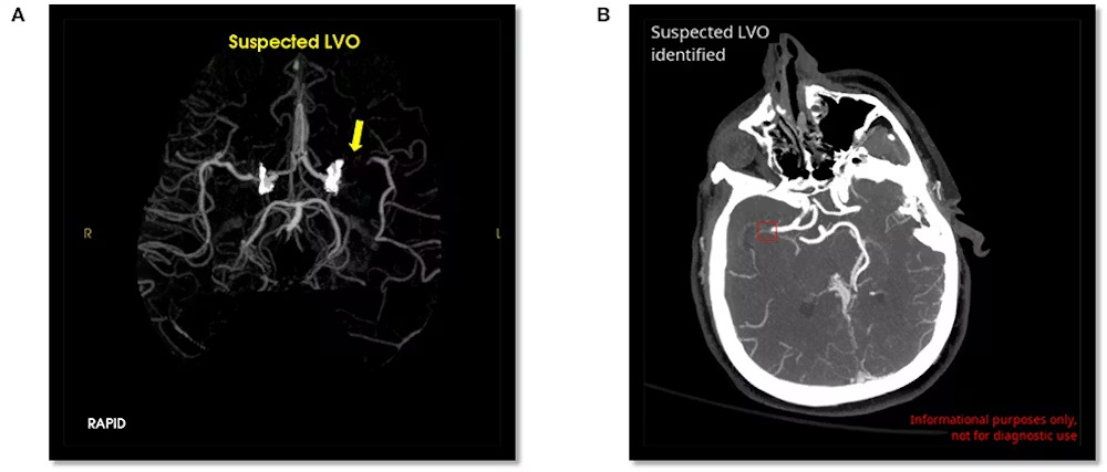 AI Replace Radiologists